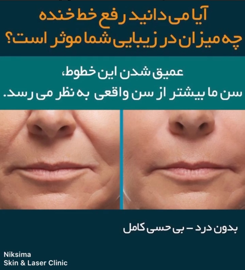 رفع خط خنده در کلینیک پوست و موی نیک سیما