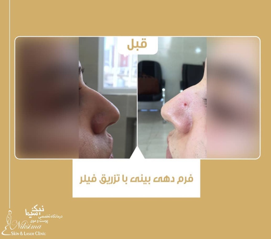 فرم دهی بینی در مرکز کلینیک پوست و موی نیک سیما