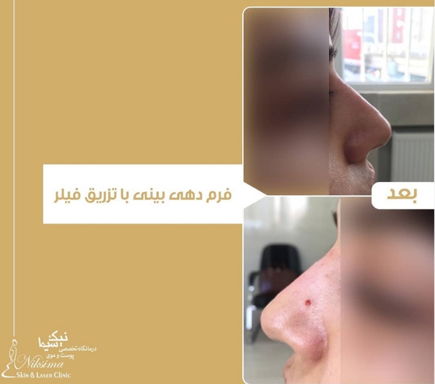 فرم دهی بینی بعد از طزریق فیلر در کلینیک پوست و موی نیک سیما